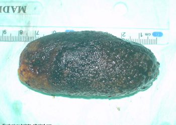 استئصال أكبر حصوة في العالم لحاجة من بلاطة البلد